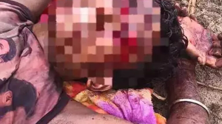 पहाड़ी पर घूमने गया युवक भालू के हमले का शिकार, चेहरे और आंख पर गंभीर चोटें, मेडिकल कॉलेज में चल रहा इलाज
